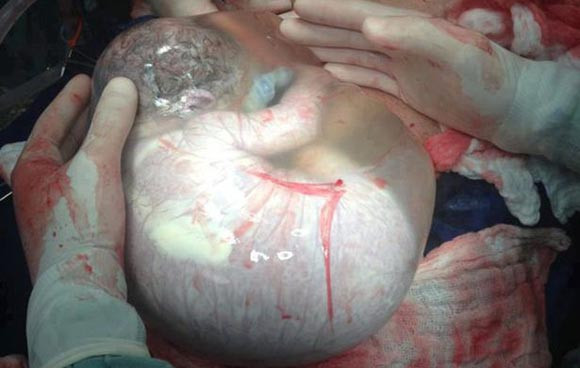 Kỳ lạ bé sơ sinh sinh ra vẫn nằm trong túi ối ảnh 1
