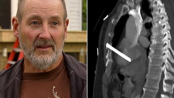 Người thợ mộc sống sót kì diệu sau khi bị đinh bắn vào tim ảnh 1