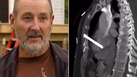 Người thợ mộc sống sót kì diệu sau khi bị đinh bắn vào tim ảnh 1