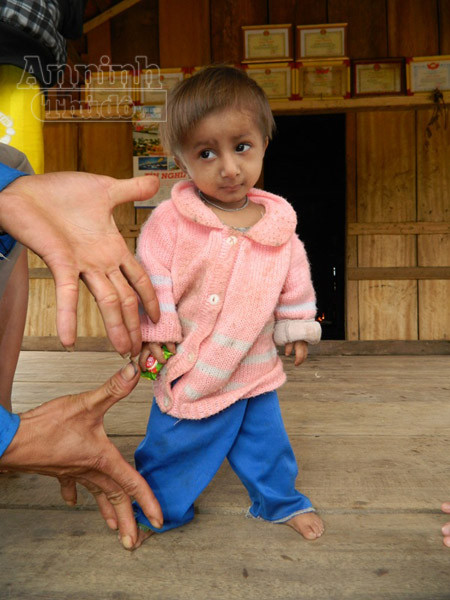 Đưa chú bé “tí hon” điều trị tuyến tỉnh ảnh 1