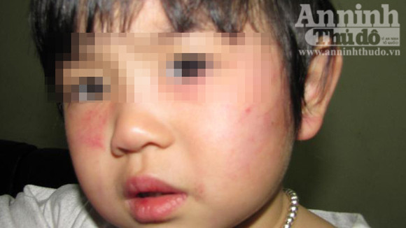 Bé K.L. với những vết bầm do cô giáo dùng thước đánh