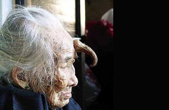 "Bí ẩn" những chiếc sừng mọc trên...đầu người ảnh 3