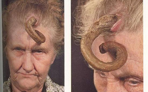 "Bí ẩn" những chiếc sừng mọc trên...đầu người ảnh 6