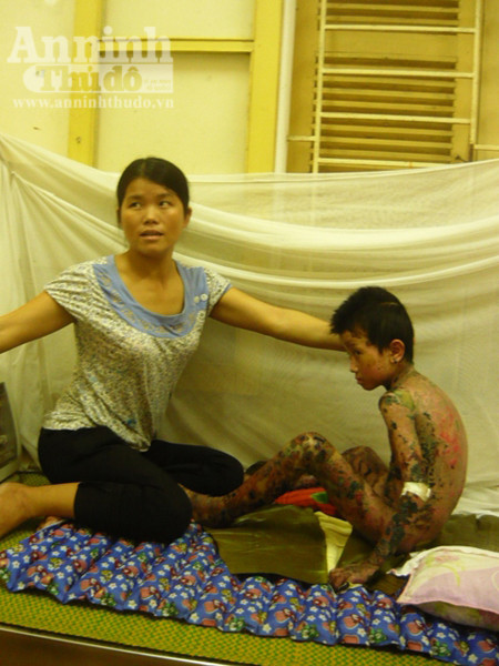 Dị ứng thuốc, bé trai 7 tuổi bị bong tróc da toàn thân ảnh 2