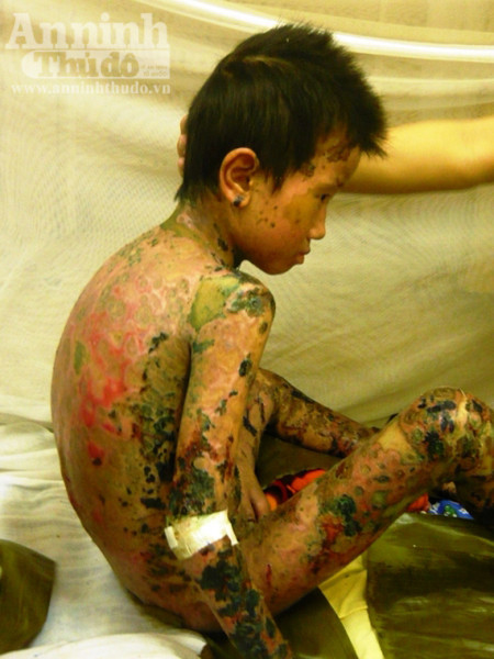 Dị ứng thuốc, bé trai 7 tuổi bị bong tróc da toàn thân ảnh 1