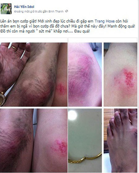 Hàng loạt sao Việt từng trầy da xước mặt vì bị cướp giật ở TP.HCM ảnh 2