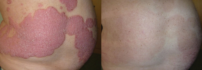 Kiểm soát bệnh vẩy nến thể mảng mạn tính hiệu quả ảnh 2