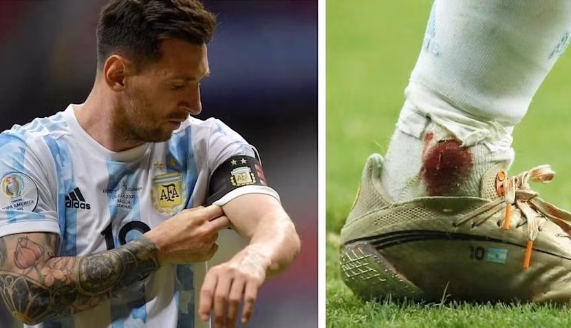 Cổ chân rỉ máu của Messi ở trận bán kết với Colombia