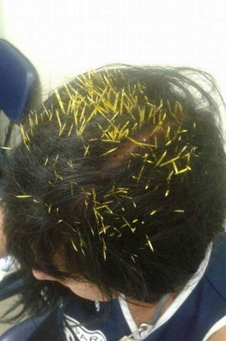 Nhập viện vì bị 200 gai nhím cắm vào đầu ảnh 1