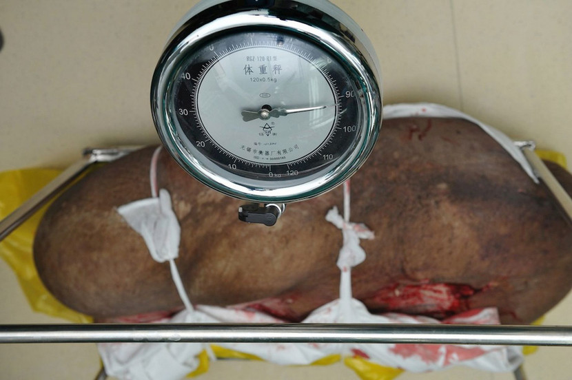 Cắt bỏ thành công “khối u nặng nhất thế giới” ảnh 5