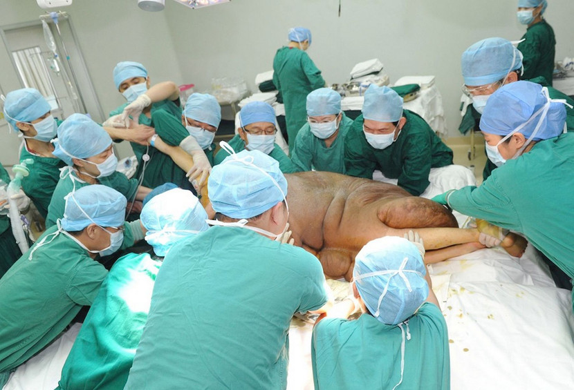 Cắt bỏ thành công “khối u nặng nhất thế giới” ảnh 3