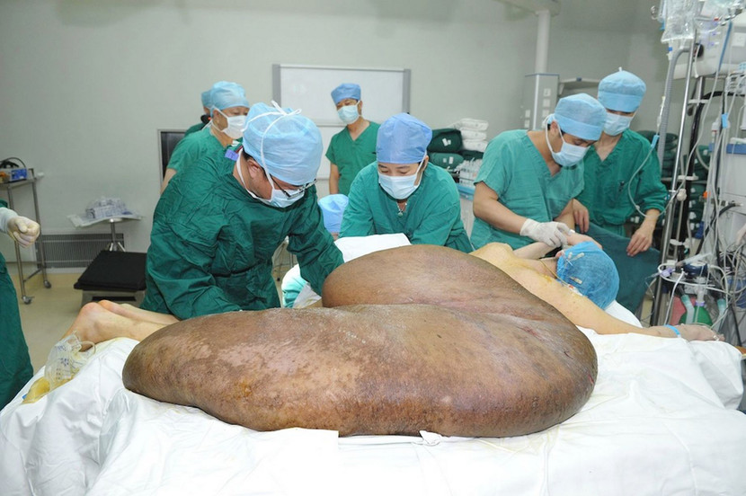 Cắt bỏ thành công “khối u nặng nhất thế giới” ảnh 4