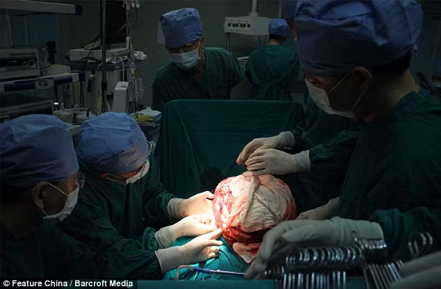 Cận cảnh ca mổ u quái Teratoma khổng lồ ở Trung Quốc ảnh 3