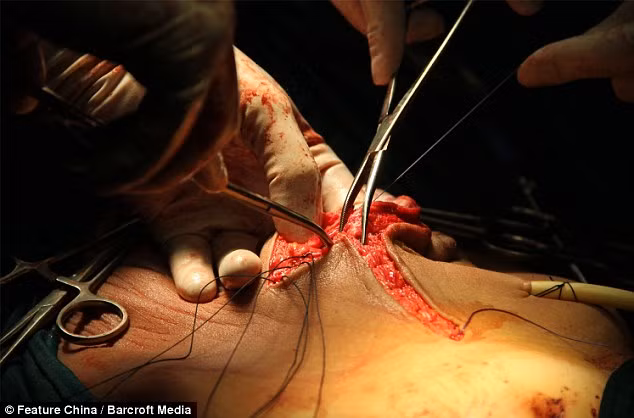 Cận cảnh ca mổ u quái Teratoma khổng lồ ở Trung Quốc ảnh 6