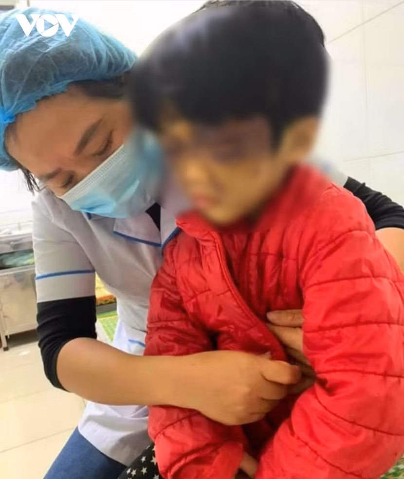 Cháu C. bầm tím vùng mắt do bị chính mẹ đẻ đánh. Ảnh: VOV