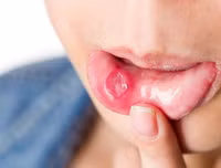 [ẢNH] Những giải pháp tự nhiên giúp điều trị nhiệt miệng cực hiệu quả