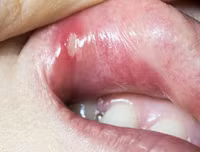 [ẢNH] Những giải pháp tự nhiên giúp điều trị nhiệt miệng cực hiệu quả