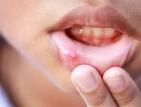 [ẢNH] Những giải pháp tự nhiên giúp điều trị nhiệt miệng cực hiệu quả