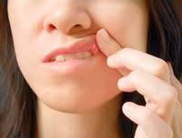 [ẢNH] Những giải pháp tự nhiên giúp điều trị nhiệt miệng cực hiệu quả