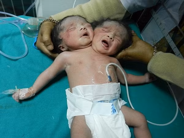 "Bé gái sơ sinh 2 đầu" ở Bangladesh ảnh 1