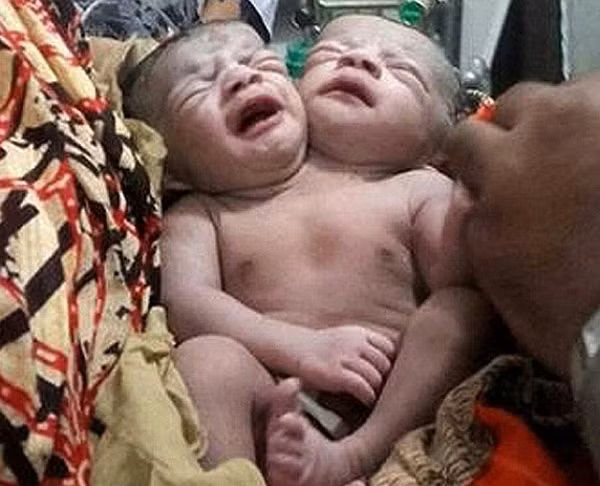"Bé gái sơ sinh 2 đầu" ở Bangladesh ảnh 2