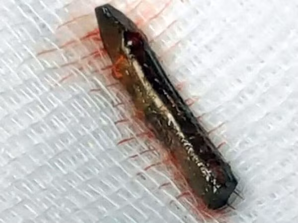 Sống sót dù đinh đâm vào tim ảnh 1