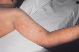 Bang Pennsylvania, Mỹ bùng phát dịch sởi
